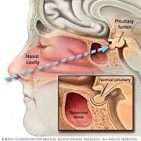 Location of Pituitary tumour